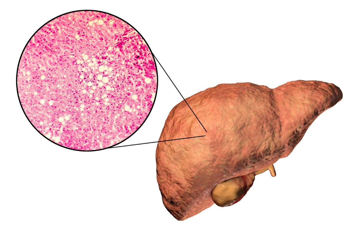 The Fatty Liver Problem in the UK