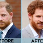 Has Prince Harry Had a Hair Transplant Facts Checked
