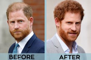 Has Prince Harry Had a Hair Transplant Facts Checked
